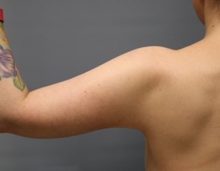 After Arm Lift Surgery Orange County CA
