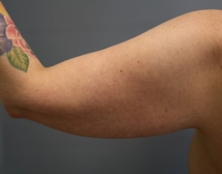 Before Arm Lift Surgery Orange County CA