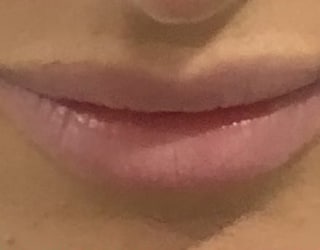Before Lip Fillers Huntington Beach CA