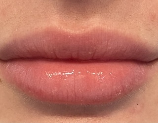 After Lip Fillers Huntington Beach CA
