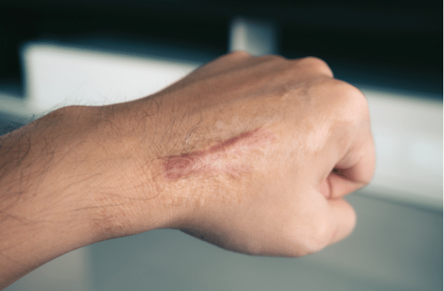 Scar on human skin keloid on hand. 0