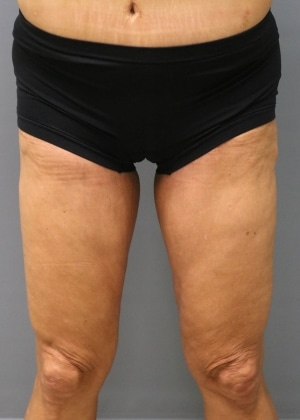 After Thigh Lift Huntington Beach CA