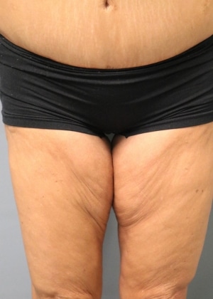 Before Thigh Lift Huntington Beach CA