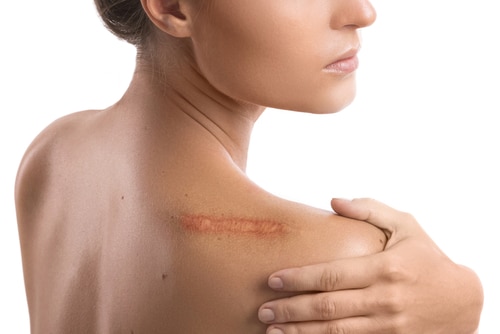 Woman,With,A,Scar,On,Her,Shoulder,Over,White,Background