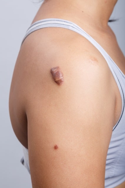 Scar Revision Surgery Huntington Beach Orange County CA