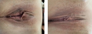 Before and After Labiaplasty Huntington Beach CA