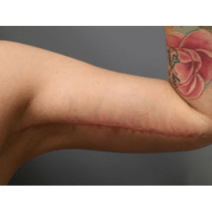 After Image: Arm Lift