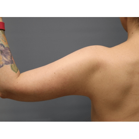 After Image: Arm Lift - back