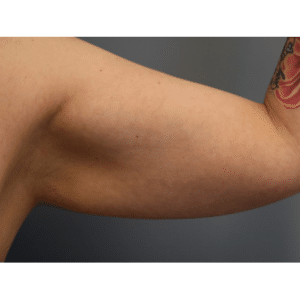 Before Image: Arm Lift