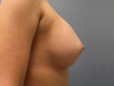 After Image: Breast Augmentation - right-side