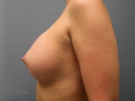 After Image: Breast Augmentation - left-side