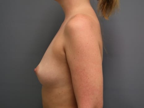 Before Image: Breast Augmentation - left-side