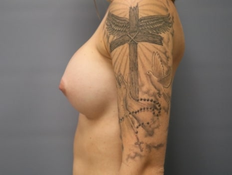 After Image: Breast Augmentation - left-side