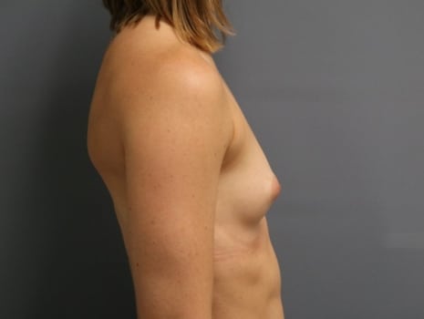 Before Image: Breast Augmentation - right-side