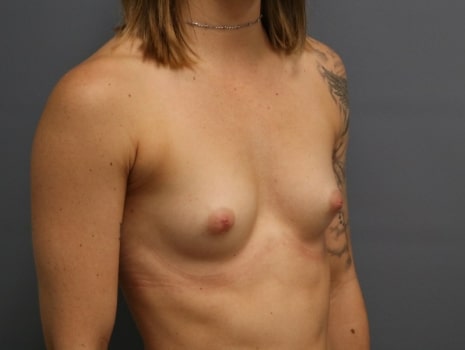 Before Image: Breast Augmentation - right-front-oblique