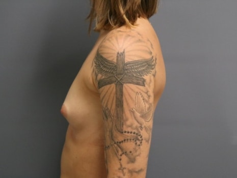 Before Image: Breast Augmentation - left-side