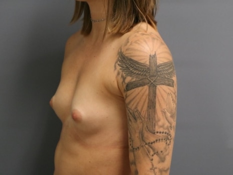 Before Image: Breast Augmentation - left-front-oblique