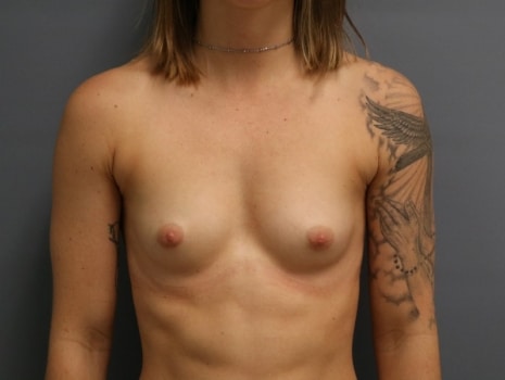 Before Image: Breast Augmentation - front
