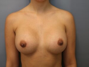 After Image: Breast Augmentation