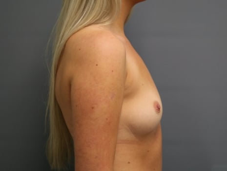 Before Image: Breast Augmentation - right-side