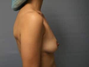 Before Image: Breast Augmentation