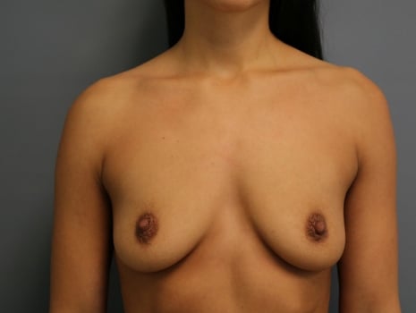 Before Image: Breast Augmentation - front
