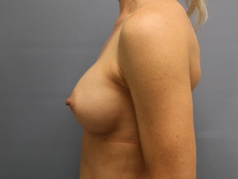 After Image: Breast Augmentation - left-side