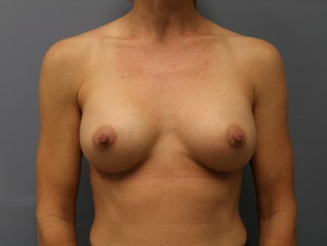 After Image: Breast Augmentation - front