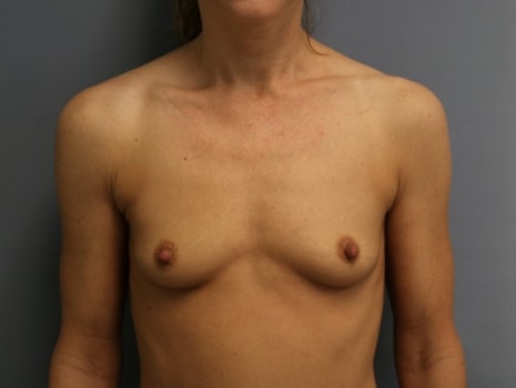 Before Image: Breast Augmentation - front