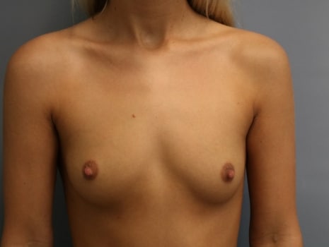 Before Image: Breast Augmentation - front
