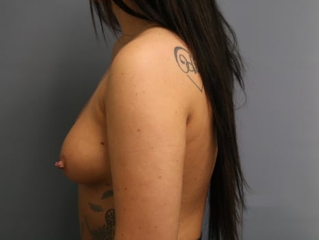 Before Image: Breast Augmentation - left-side