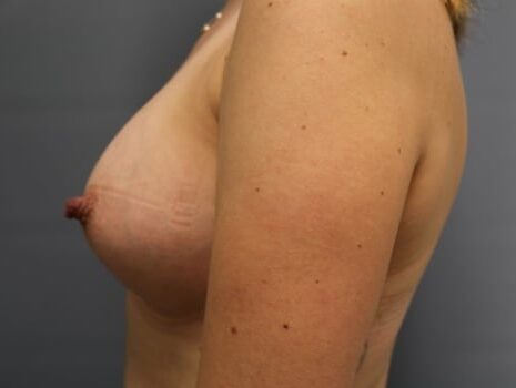 After Image: Breast Augmentation - left-side