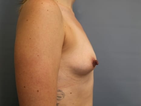 Before Image: Breast Augmentation - right-side