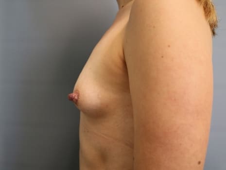 Before Image: Breast Augmentation - left-side
