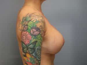 After Image: Breast Lift