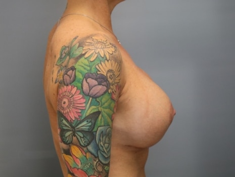 After Image: Breast Lift - right-side