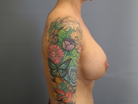 Before Image: Breast Lift - right-side