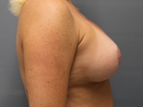 After Image: Breast Lift - right-side