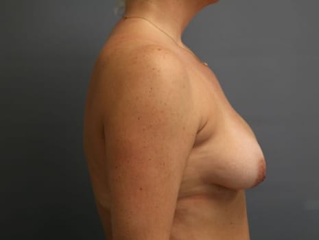 Before Image: Breast Lift - right-side