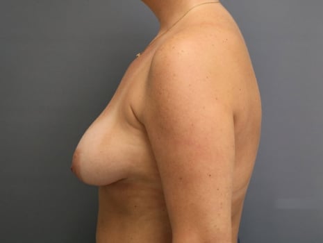 Before Image: Breast Lift - left-side
