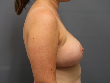After Image: Breast Reduction - right-side