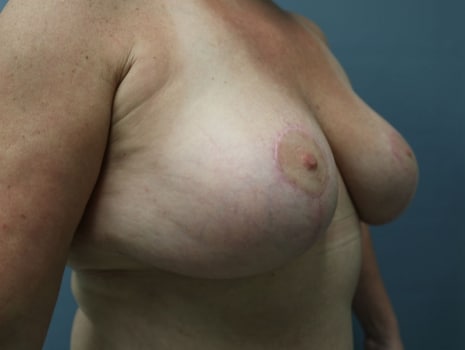 After Image: Breast Reduction - right-front-oblique