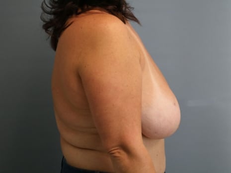 Before Image: Breast Reduction - right-side
