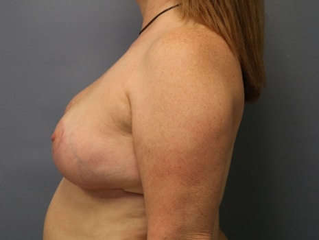 After Image: Breast Reduction - left-side