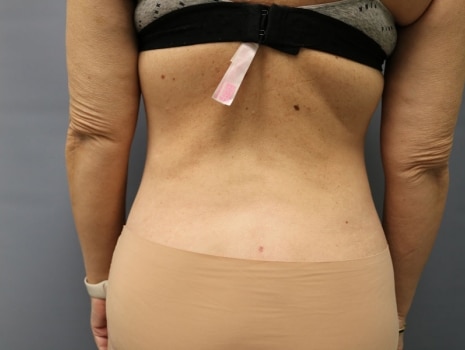 After Image: Liposuction - back