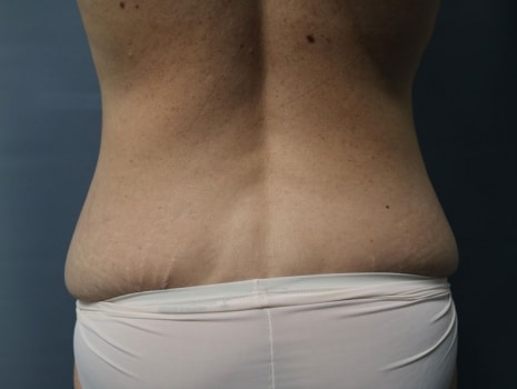 Before Image: Liposuction - back
