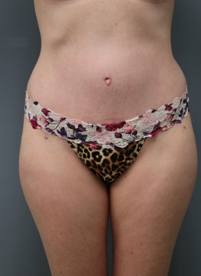 After Image: Mommy Makeover - front