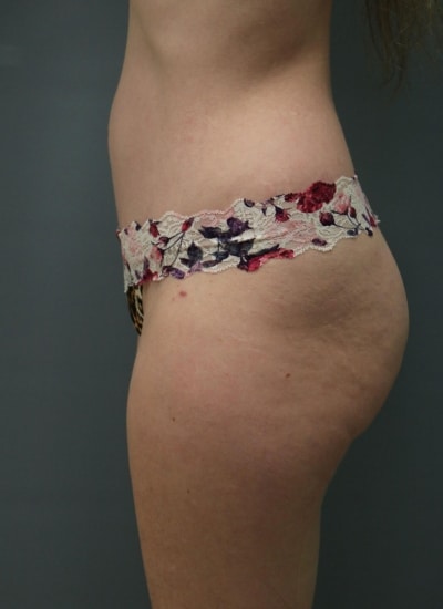 After Image: Mommy Makeover - left-side