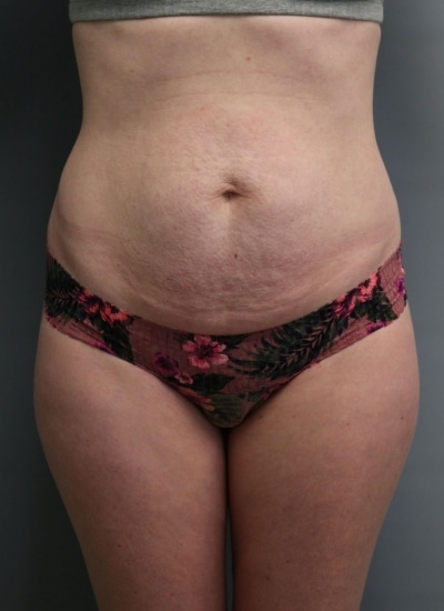 Before Image: Mommy Makeover - front