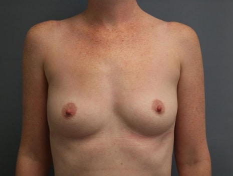 Before Image: Mommy Makeover - front